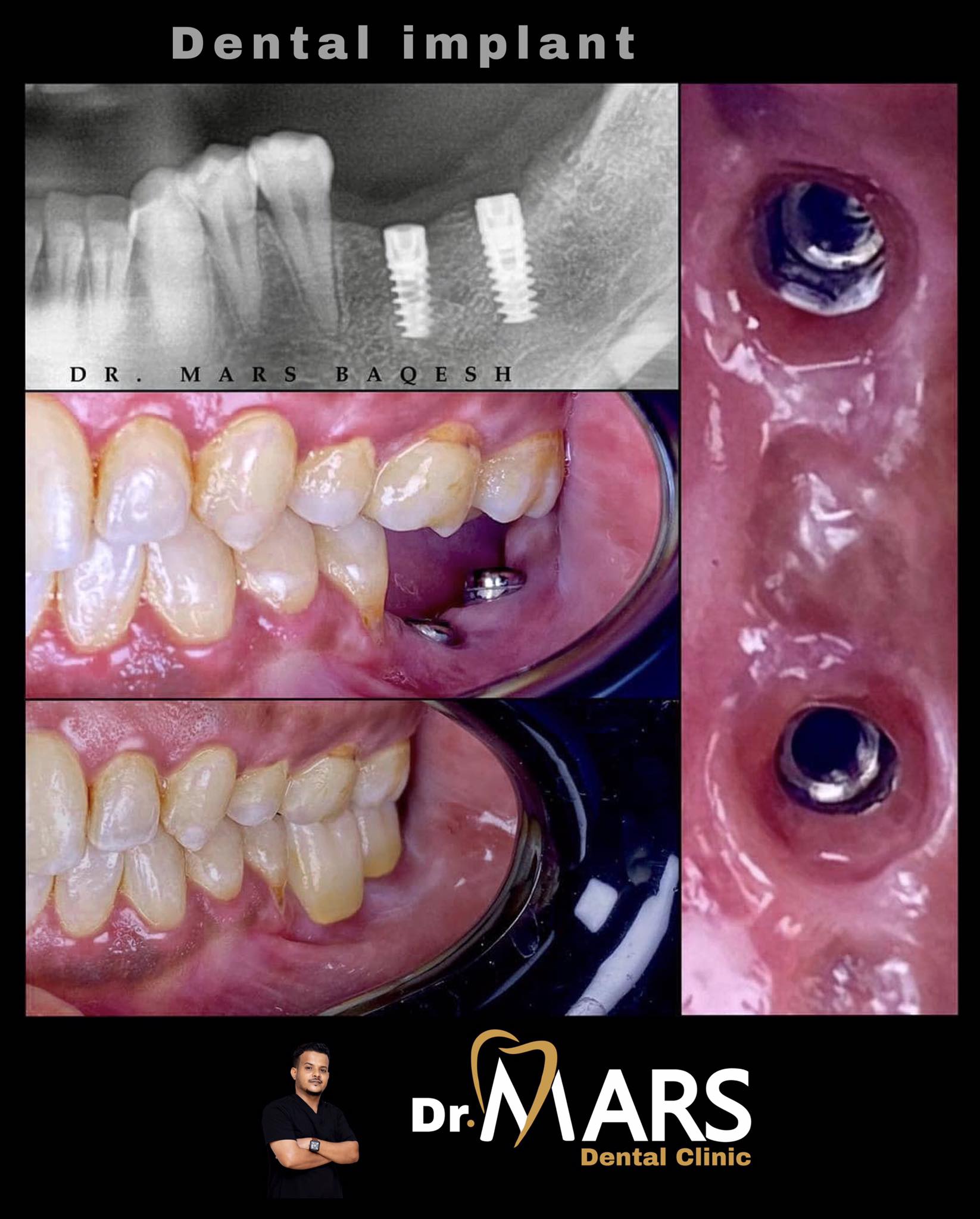 Dental Implants (Ilka Beerid)